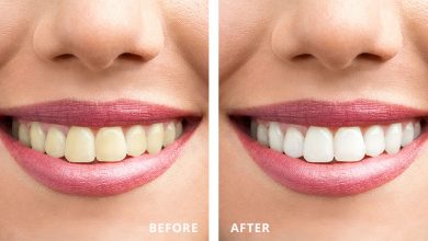 8 Cosmetic Dental Treatments to Achieve a Brilliant Smile