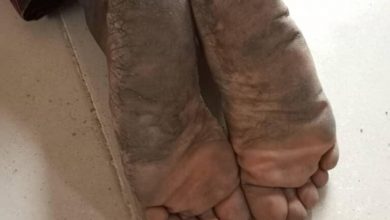  Leprosy: Two Suspected Cases Found In Ibadan