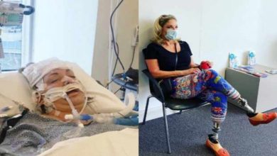 Australian Woman Undergoes 36 Surgeries After Mosquito Bite In Nigeria