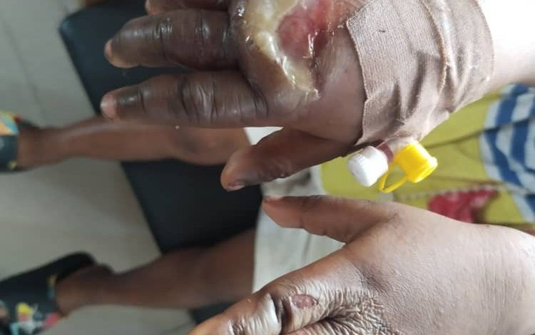 Woman Dips Five-Year-Old Daughter’s Hands In Hot Water 