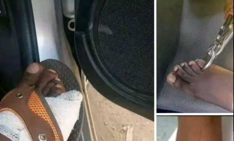 Zimbabweans Selling Toes For $20,000 To Survive