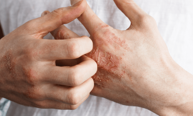 15 Causes of Eczema