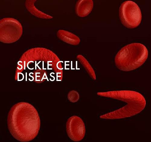 Reason sickle cell is not a death sentence — SCFN
