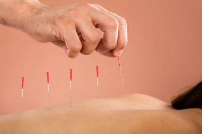 15 Major Functions of Acupuncture in Nigeria