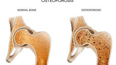 Top 15 Signs and Effect of Osteoporosis