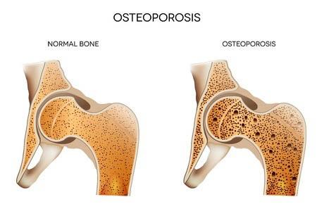 Top 15 Signs and Effect of Osteoporosis