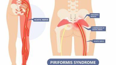 Top 15 Signs and Effect of Piriformis Syndrome