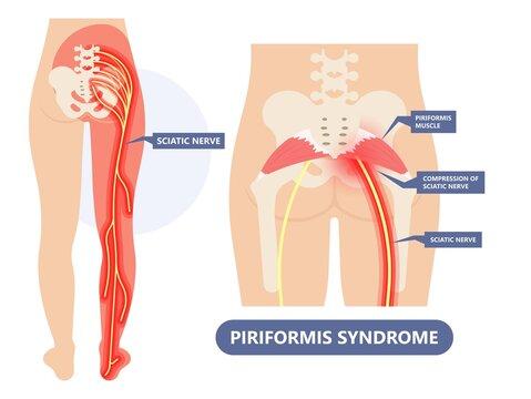 Top 15 Signs and Effect of Piriformis Syndrome