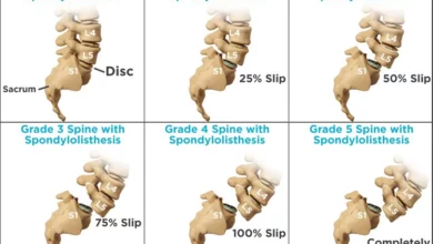 Top 15 Signs and Effect of Spondylolisthesis