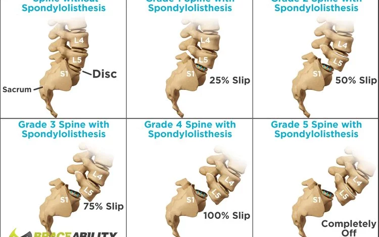 Top 15 Signs and Effect of Spondylolisthesis