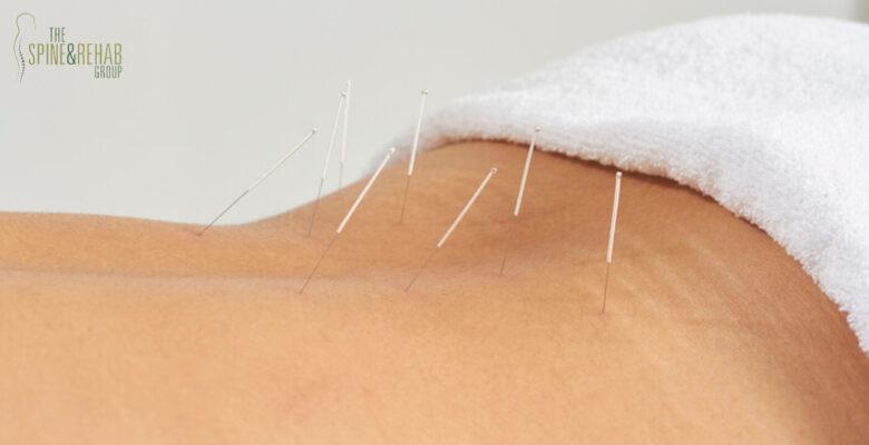 Best Acupuncture for Waist Pain